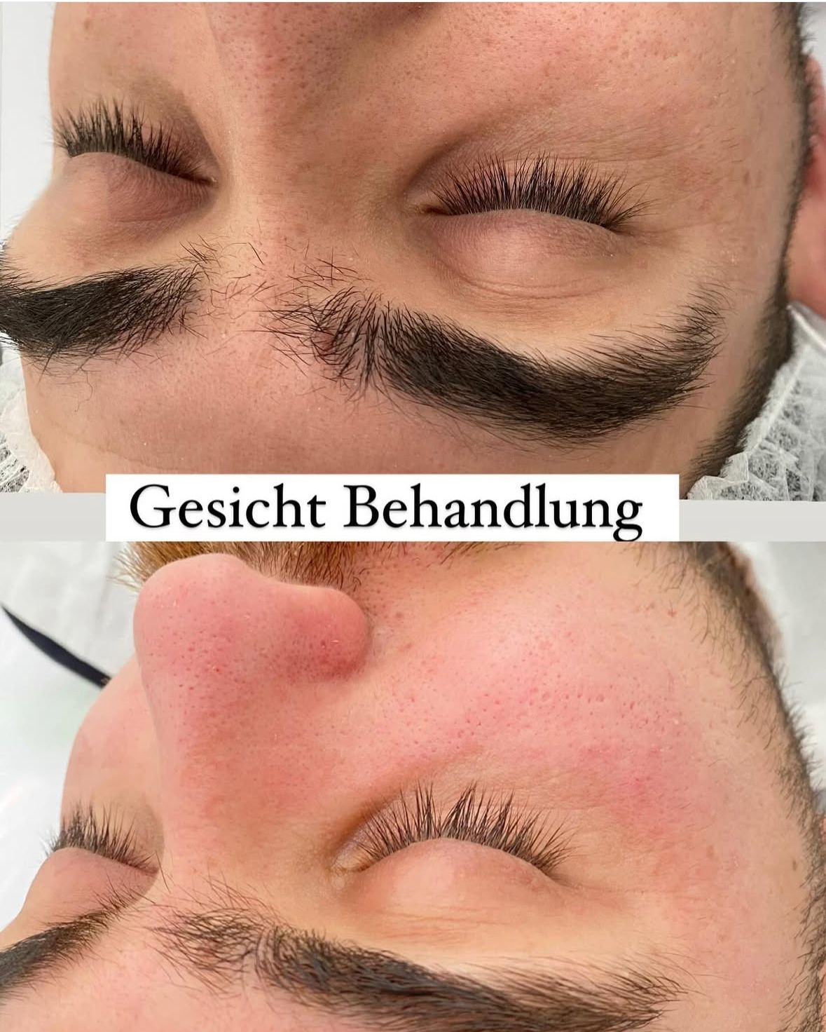 Gesichtsbehandlung Vorher Nachher